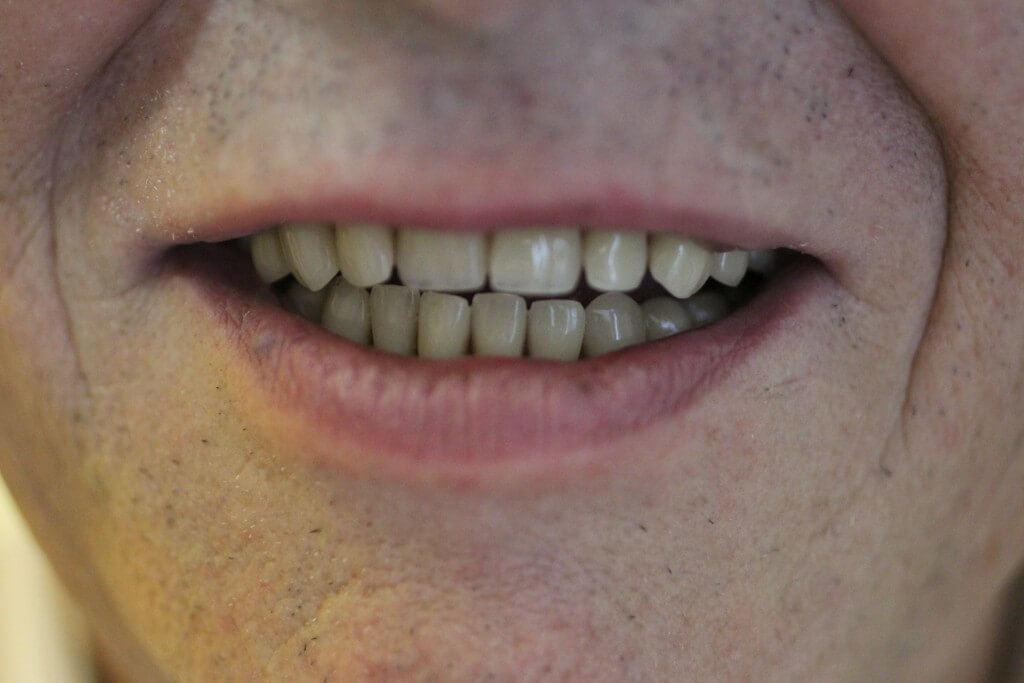 ragasztás nélküli fogsor